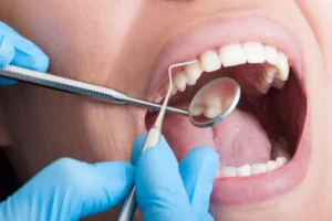 Scaling gigi adalah prosedur pembersihan karang gigi (plak atau sisa makanan yang mengeras) menggunakan alat khusus seperti ultrasonic scaler.