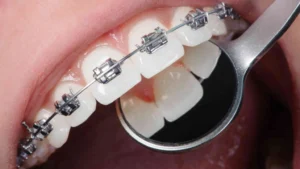 Behel self ligating adalah salah satu jenis kawat gigi modern yang kini semakin populer. Berbeda dengan behel konvensional yang menggunakan karet elastik, sistem ini dilengkapi klip khusus pada bracket untuk menahan kawat gigi.