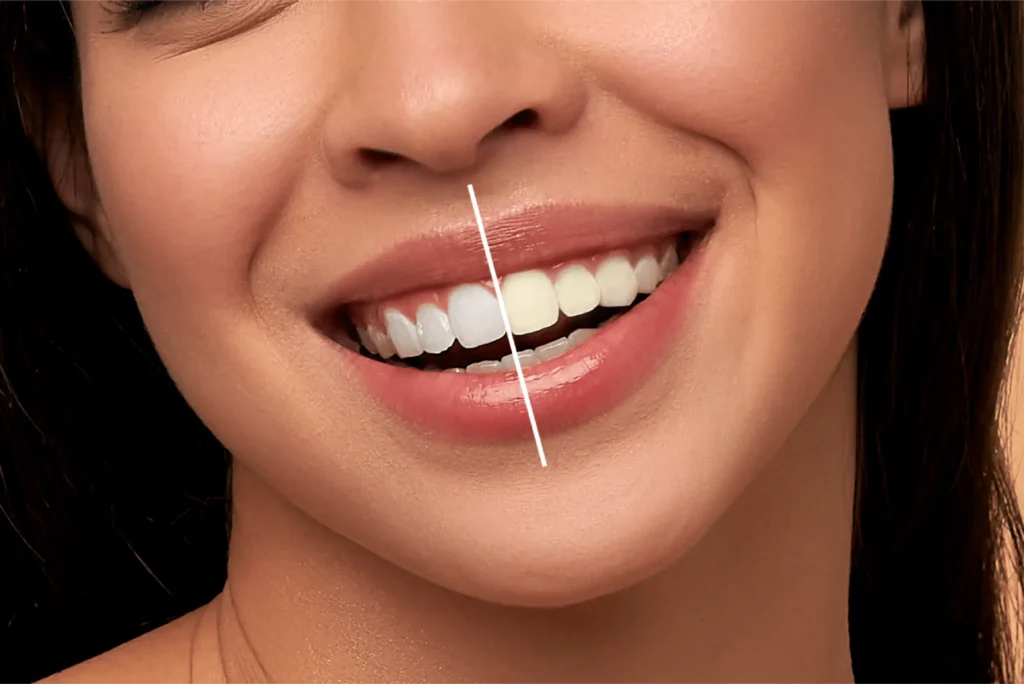 Bleaching gigi atau pemutihan gigi adalah prosedur yang dilakukan dokter gigi dengan bahan khusus seperti hidrogen peroksida atau karbamid peroksida.
