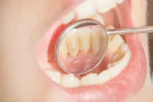 Karang gigi (dental calculus) adalah plak gigi yang sudah mengeras akibat bercampur dengan mineral dari air liur.