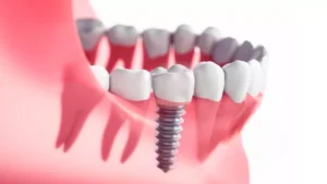 Tanam gigi atau gigi palsu implan (dental implant) adalah akar gigi buatan yang ditanam ke dalam tulang rahang untuk menggantikan gigi yang hilang.