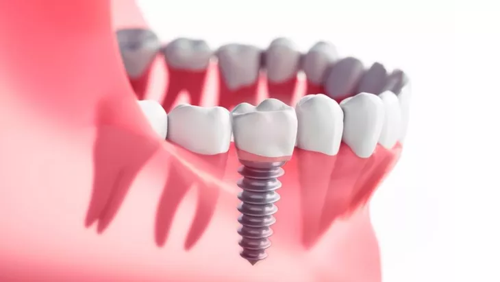Tanam gigi atau gigi palsu implan (dental implant) adalah akar gigi buatan yang ditanam ke dalam tulang rahang untuk menggantikan gigi yang hilang.