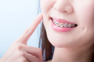 Behel gigi atau orthodontic appliance adalah alat untuk memperbaiki posisi gigi dan rahang yang tidak sejajar (maloklusi).
