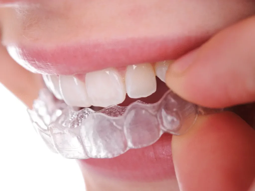 Setelah perawatan ortodonti selesai dan behel dilepas, gigi masih berada pada fase penyesuaian. Retainer menjaga posisi gigi agar tetap stabil dan mencegahnya bergeser kembali ke posisi semula. Tanpa retainer, hasil perawatan ortodonti yang sudah dilakukan selama berbulan-bulan bahkan bertahun-tahun bisa hilang hanya dalam waktu singkat.