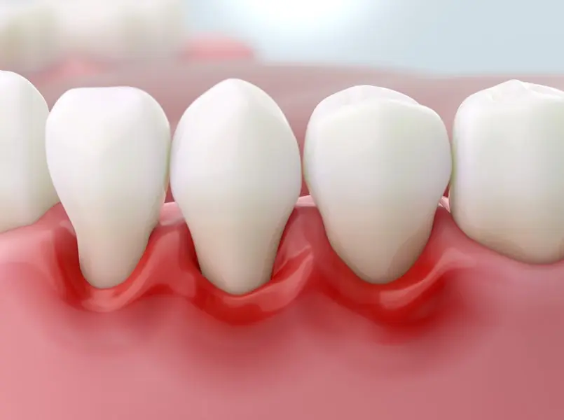 Periodontitis adalah infeksi kronis pada jaringan penyangga gigi, termasuk gusi, ligamen periodontal, dan tulang alveolar, yang muncul akibat peradangan berkepanjangan