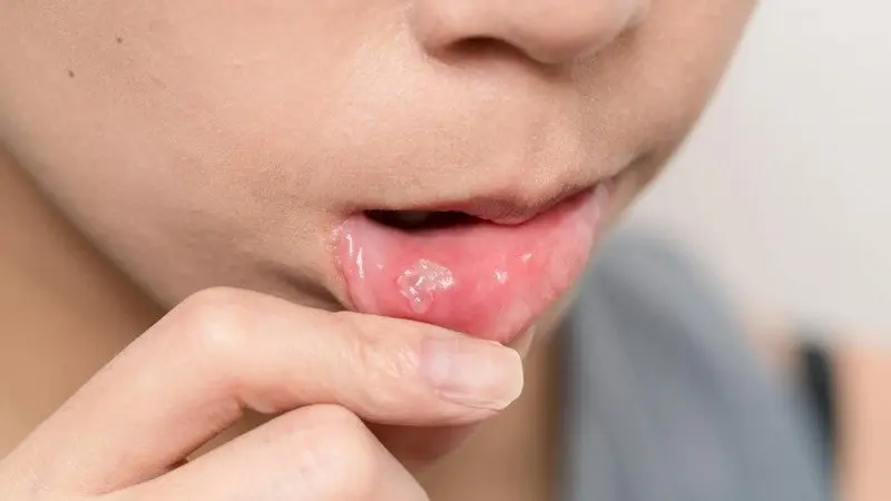 Sariawan atau stomatitis aphtosa adalah peradangan pada jaringan lunak di dalam mulut, termasuk bibir bagian dalam, pipi, gusi, lidah, atau langit-langit