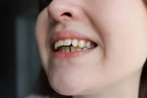 Overbite adalah kondisi ketika gigi depan rahang atas menutupi sebagian gigi depan rahang bawah secara vertikal. Posisi gigi depan rahang atas sedikit maju (2-4 mm) adalah normal, namun jika penutupannya terlalu dalam (deep overbite), kondisi ini dapat memengaruhi fungsi mengunyah, estetika, dan kesehatan gigi secara keseluruhan