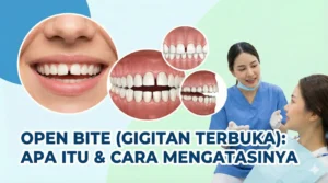 Open bite adalah kondisi ketika gigi atas dan gigi bawah tidak saling bertemu saat mulut menutup