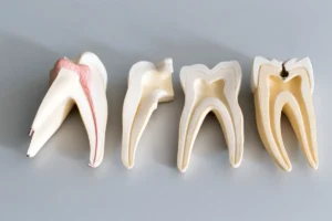 Sisa akar gigi, atau dikenal secara medis sebagai gangren radix, adalah kondisi ketika mahkota gigi sudah hancur akibat karies atau trauma, tetapi akar gigi tertinggal di dalam gusi atau tulang rahang