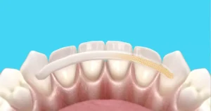 Dalam kedokteran gigi, tingkat kegoyangan dinilai berdasarkan derajat tertentu untuk menentukan cara mengatasi gigi goyang yang paling tepat serta prognosisnya