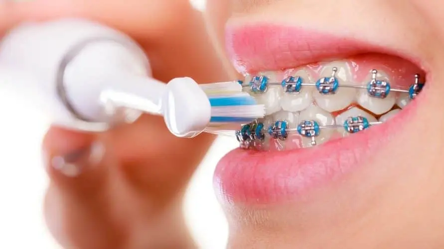 Panduan cara merawat behel gigi saat puasa Ramadan 2026 Malang agar tidak sakit. Pelajari tips membersihkan behel dan jadwal kontrol bagi pengguna behel di Malang