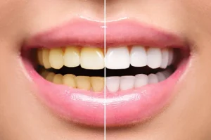 Ingin tampil percaya diri saat Lebaran? Lakukan bleaching Lebaran 2026 di Malang bersama ConfiDental. Proses cepat, hasil cerah, dan aman