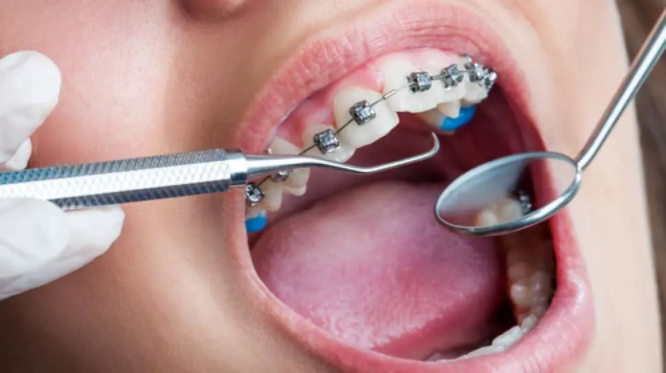 Manfaatkan liburan untuk merapikan gigi! Bandingkan aligner transparan vs behel 2026 dan temukan harga pasang behel di Madiun sesuai kebutuhanmu