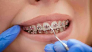 Masih bingung memilih jenis jenis behel gigi? Kenali perbedaan behel metal, keramik, self-ligating, lingual, hingga clear aligner sebelum pasang