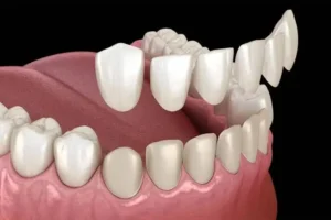 Ingin veneer gigi? Kenali efek samping veneer gigi, mulai dari gigi sensitif hingga risiko veneer retak