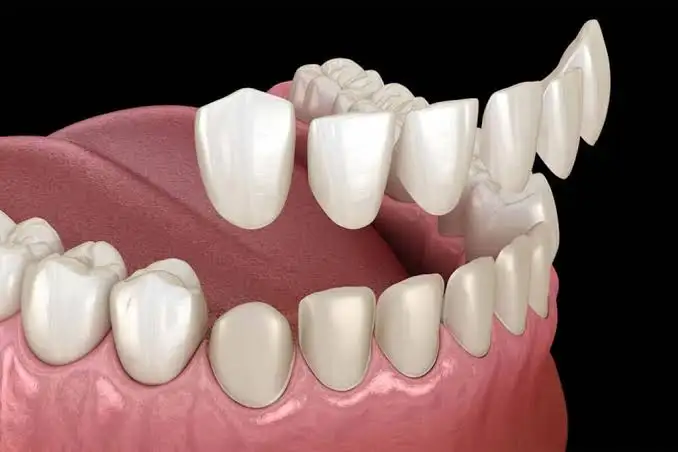 Ingin veneer gigi? Kenali efek samping veneer gigi, mulai dari gigi sensitif hingga risiko veneer retak