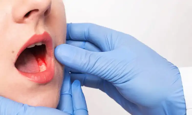Pelajari gejala gingivitis, penyebab gusi berdarah saat sikat gigi, beda gusi sehat vs radang gusi, serta solusi pembersihan karang gigi