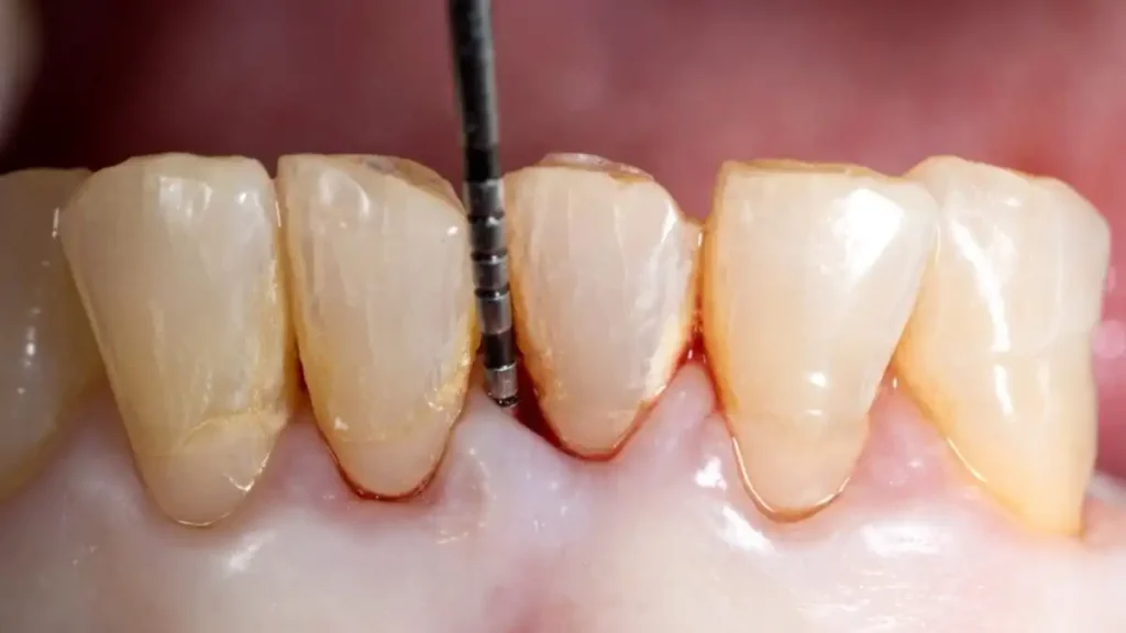 Jangan biarkan radang gusi merusak tulang gigimu! Pelajari gejala periodontitis, penyebab gusi turun, dan perawatan medis tingkat lanjut