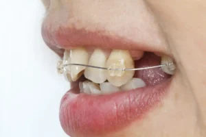 Gigi tonggos bikin enggan tersenyum? Pahami penyebab protrusi, dampaknya bagi kesehatan, serta opsi merapikannya dengan behel & aligner