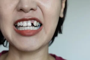 Gigi ompong dapat memengaruhi fungsi mengunyah dan penampilan