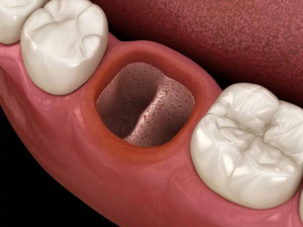 Nyeri setelah cabut gigi semakin berat? Kenali gejala dry socket atau alveolar osteitis, cara penanganan, dan perawatan luka cabut gigi yang tepat